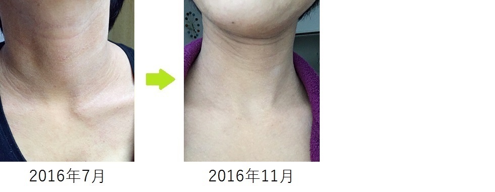 Desquamation of the neck