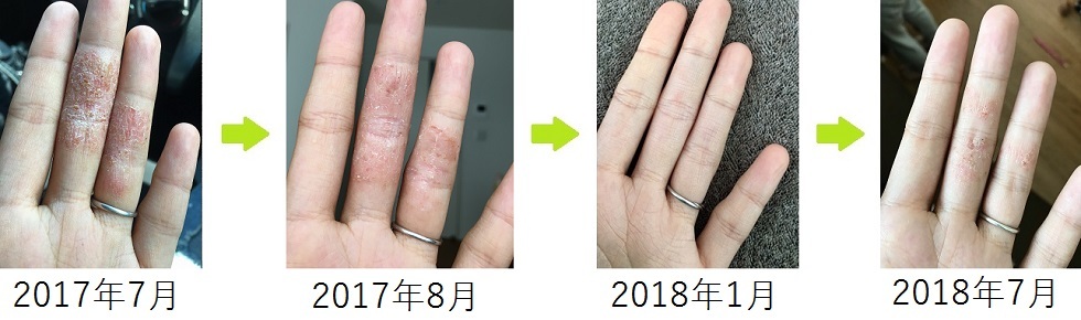 Eczema of fingers